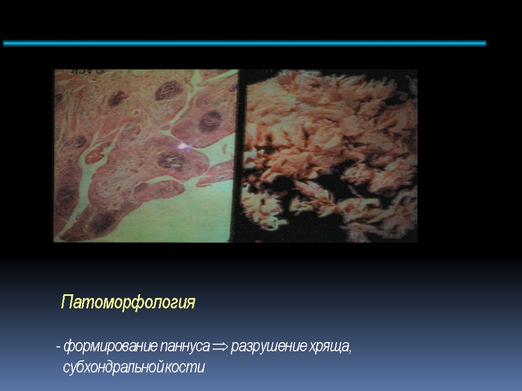 Патоморфология - формирование паннуса  разрушение хряща, субхондральной кости